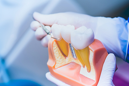 歯の機能性・審美性を回復する「インプラント治療」