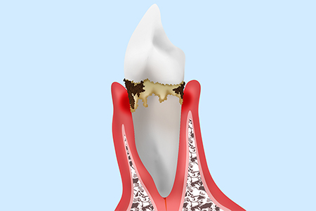 軽度歯周炎