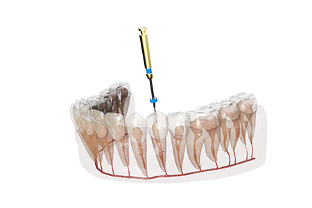 歯髄の虫歯菌を除去する「根管治療」