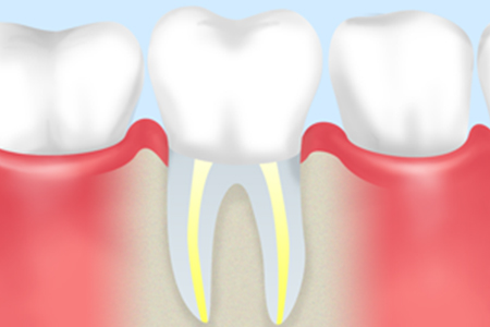 STEP05　歯冠修復処置
