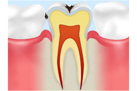 C1　外側のエナメル質の虫歯