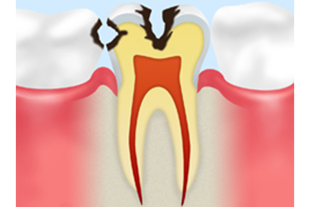 C2　内部の象牙質の虫歯