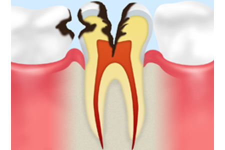C3　歯の神経の虫歯