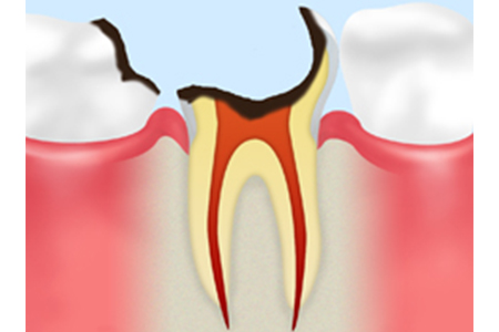 C4　歯の根まで達した虫歯